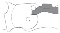 Diagram of a Compression Lock